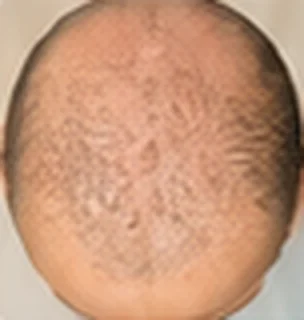 Antes: área com alopecia no topo da cabeça
