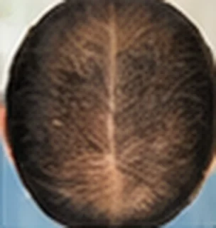 Depois: crescimento e fortalecimento dos fios após tratamento para alopecia